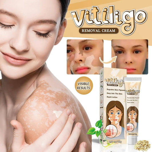 Vitiligo Removal Cream